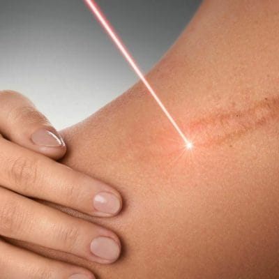 usuwanie - Laserowe usuwanie zmian skórnych | od 350zł | Warszawa