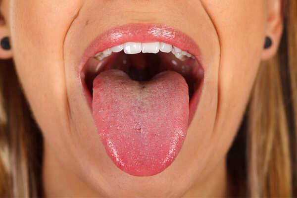 what is vapers tongue image of
