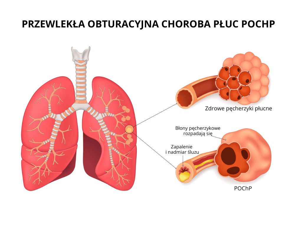 Obraz przedstawiający uszkodzone płuca lub drogi oddechowe, symbolizujący negatywne skutki długotrwałego palenia tradycyjnych papierosów, takie jak POChP i rak.