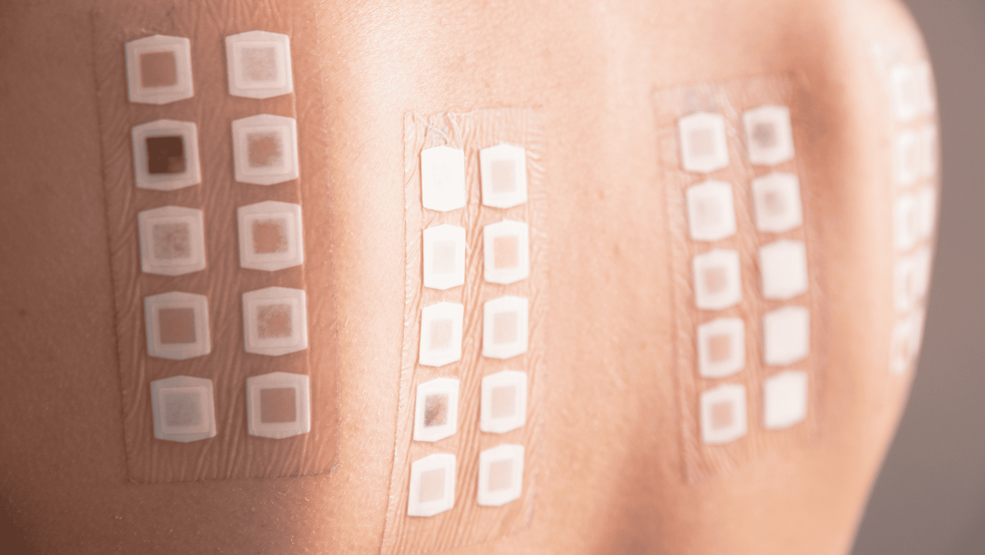 Lekarz dermatolog lub alergolog wykonujący naskórkowe testy płatkowe, aplikując plastry z próbkami substancji, w tym glikolu propylenowego, na skórę pleców pacjenta.